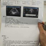 胎儿颈部w型压迹（胎儿颈部U形压迹是什么意思）