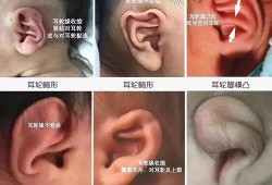 胎儿耳朵畸形的原因（胎儿耳朵畸形的原因是怎样造成的）