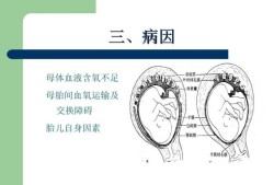 胎儿腔内（胎儿腔内窘迫）
