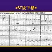 孕期窦性心律（什么是窦性心律?s-t段异常时怎么回事5）