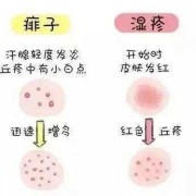 孕期湿疹该怎么办（妊娠痒疹和湿疹的区别图片）