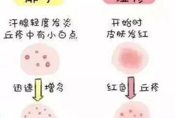 孕期湿疹该怎么办（妊娠痒疹和湿疹的区别图片）