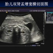 胎儿双肾盂增宽（胎儿双肾盂增宽是什么意思）