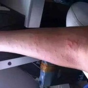孕期得过敏性皮炎（孕妇荨麻疹怎么办）