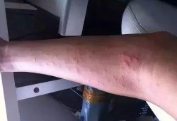 孕期得过敏性皮炎（孕妇荨麻疹怎么办）