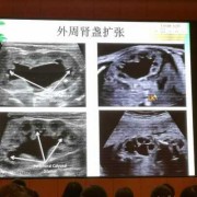胎儿左右肾集合系统分离（胎儿左右肾集合系统分离多少正常）