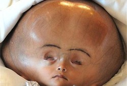 胎儿 脑积水（胎儿脑积水能够自己吸收的几率有多大）