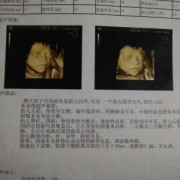 胎儿大排畸（大排畸多少周可以做）