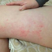 孕期大腿内侧红了一块，又痛是怎么回事,孕期大腿根部红肿疼痛