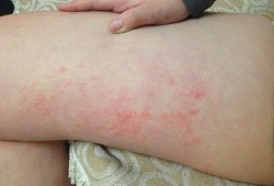 孕期大腿内侧红了一块，又痛是怎么回事,孕期大腿根部红肿疼痛