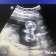 胎儿三线征（胎儿三线征有可能男孩）