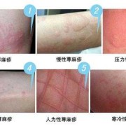 怀孕了得荨麻疹怎么办,孕期荨麻疹症状图片大全