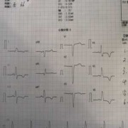 孕期心电图异常（孕期心电图异常是什么原因）