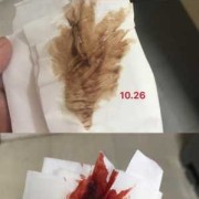 怀孕初期出血多久会好,怀孕期间流血了怎么回事