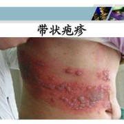 孕期带状疱疹如何治疗,孕期带状疱疹对胎儿的影响
