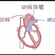 乳腺导管增宽是怎么回事,胎儿动脉导管增宽原因