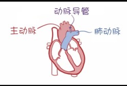 乳腺导管增宽是怎么回事,胎儿动脉导管增宽原因