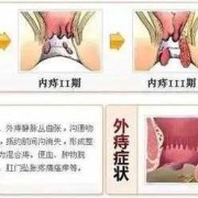 怀孕期间有痔疮怎么治（孕期得痔疮怎么治疗呢）