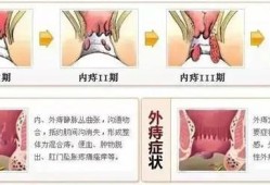 怀孕期间有痔疮怎么治（孕期得痔疮怎么治疗呢）
