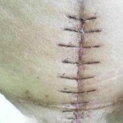 胎儿37周可以剖腹产吗（37周做剖腹产对孩子有影响吗）