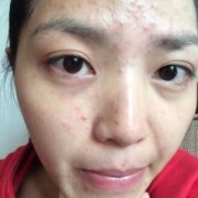 怀孕脸上长痘痘是什么原因,孕期痘印如何祛除