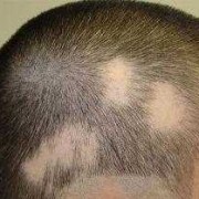 胎儿斑秃（斑秃会影响胎儿吗）