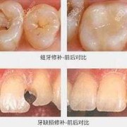 备孕期能补牙吗（备孕期能补牙吗?）