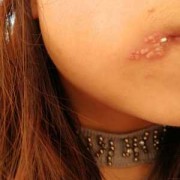 孕期嘴角长疱疹怎么办（嘴角长疱疹如何快速治愈）