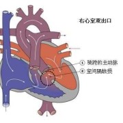 胎儿右室双出口（胎儿右室双出口是什么原因造成的）