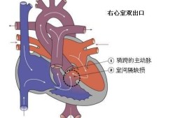 胎儿右室双出口（胎儿右室双出口是什么原因造成的）