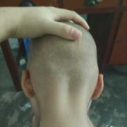 胎儿3个半月（宝宝3个月了,后脑勺下方有一块鼓的）