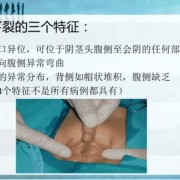 胎儿尿道下裂（尿道下裂是什么原因）