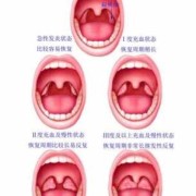 孕妇有炎症对胎儿有影响吗,孕妇扁桃体炎能自愈吗