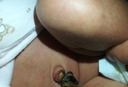 孕期肚脐炎（孕期肚脐炎对宝宝有影响吗）