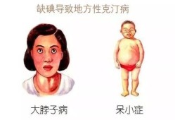孕期尿碘低（孕期尿碘低对胎儿有什么影响）