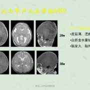 胎儿脑磁共振（胎儿脑磁共振检查对小孩有影响吗）