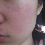 孕期脸上过敏怎么办,孕期脸上过敏红肿痒怎样快速消除