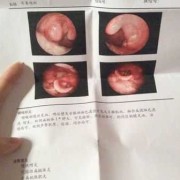 孕妇嗓子发炎肿痛怎么办,孕期喉咙肿痛怎么办咽口水都痛怎么办
