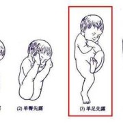 胎儿单臀（胎儿单臀先露是什么意思）