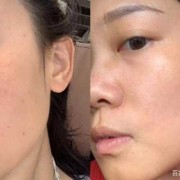 孕期长斑怎么办（孕期长斑怎么办以后会退吗）