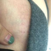 怀孕期间乳头痒怎么办（孕妇胸部瘙痒怎么治）