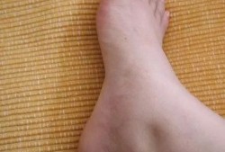 孕妇脚肿是什么原因,孕期水肿会增加体重吗?