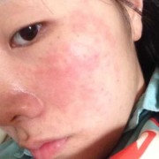 孕妇脸部过敏了怎么办,孕期过敏了怎么办对胎儿有没有影响