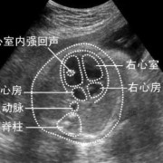 胎儿左右心室强光点（胎儿左右心室强光点是怎么回事）