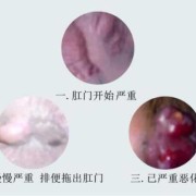 怀孕痔疮流血怎么办,怀孕期间肛门出血对胎儿有影响吗