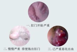 怀孕痔疮流血怎么办,怀孕期间肛门出血对胎儿有影响吗