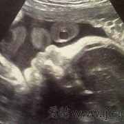 胎儿头特别小（怀孕18周时B超显示孩子腿短怎么办）