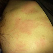 孕期感染风疹病毒症状（孕期感染风疹病毒症状）
