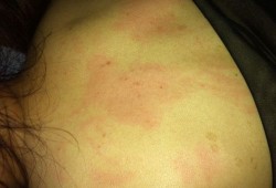 孕期感染风疹病毒症状（孕期感染风疹病毒症状）