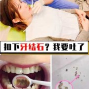 孕妇能洗牙吗有牙结石,孕期可以洗牙吗有影响吗